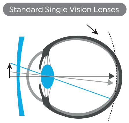 myopi-x myopia control lenses comparison