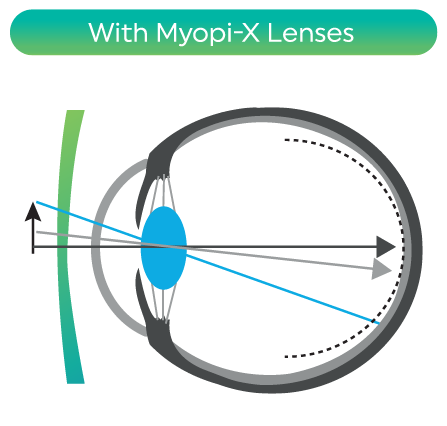 myopi-x myopia control lenses comparison